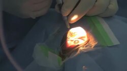 surgery cataract eye Stock Footage