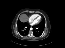 Thorax CAT Scan Stock Footage