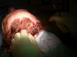 Facelift operation, clip 13 of 24. Surgeon tying sutures attached to a small screw in the patient's skull. The screw anchors the sutures, which holds the skin in place after the operation Stock Footage