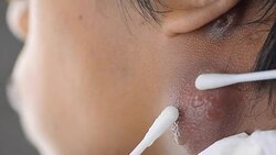 doctor use cotton brush to remove seropus from infamation of wound Stock Footage