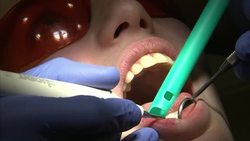 Teeth Cleaning at Dentist Office -Stock Shots News Clip