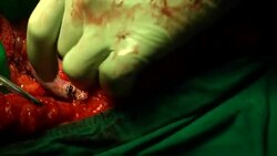 surgery operation Stock Footage