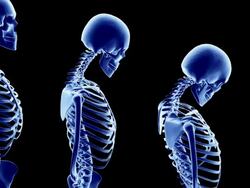 Progression of osteoporosis, shown with graphics of X-rays of skeletons at worsening stages of the condition. Stock Footage