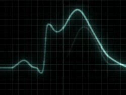 DuringAHeartAttackECG Stock Footage