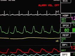 ECG (HD) Stock Footage