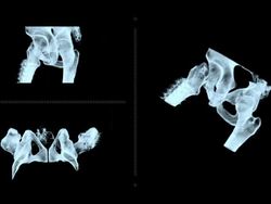 Hip CT Scan Stock Footage
