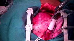 open heart surgery, close up Stock Footage