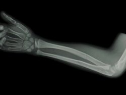 ZI on an x-ray of the forearm of a seven year old boy showing a fracture of the forearm Stock Footage