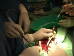 open-heart sergery, doctors around the operated child, in wolfson hospital. Save A Child''s Heart project. Stock Footage