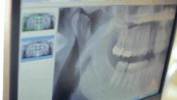 Dental diagnose graphic on computer screen Stock Footage