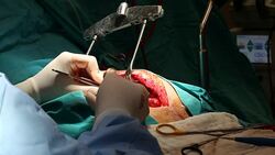 Close up view of open heart surgery Stock Footage