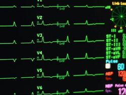 ECG monitor Stock Footage