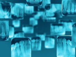 Dental X-Ray Stock Footage