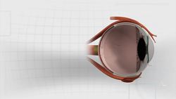 Woman undergoes bionic eye surgery in Honolulu to restore vision Instructional Video