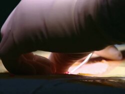  CU TU TD Surgeon stitching up / Cagliari, Sardinia, Italy Stock Footage