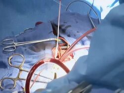 CU  ZI Doctors operating on childs heart surgery /  Little Rock, Arkansas, USA Stock Footage