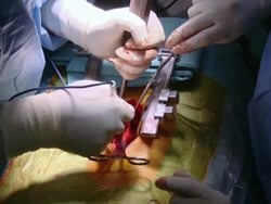 CU Surgeon operating on spine / Cagliari, Sardinia, Italy Stock Footage