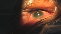 step 1. Surgery Cataract Eye. Category-B Stock Footage