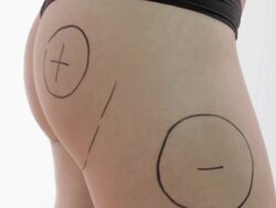 HD DOLLY: Buttock And Abdominoplasty Plastic surgery Stock Footage