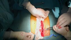 Heart surgeon Stop bleeding sternotomy incision Stock Footage