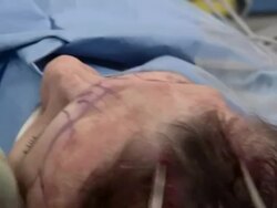 Facelift operation, clip 9 of 24. Stock Footage