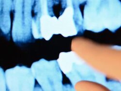 Dental x-ray on digital tablet Stock Footage