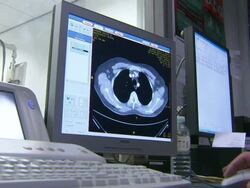 Doctor Looking Over CT Scan On Computer News Clip