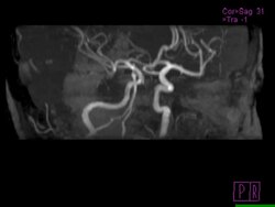 Circle of Willis. Rotating magnetic resonance angiography (MRA) scan of blood vessels in the circle of Willis (centre) in the brain. This network of arteries at the base of the brain supply the organ with oxygenated blood. Stock Footage