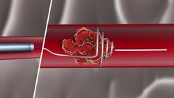 Blood clots and minimum-invasive retrieval methods Instructional Video