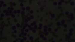 Myeloblast in Leukemia disease under microscope 1000X Stock Footage