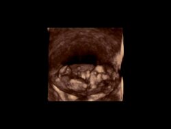 Foetus in the womb, rotating 3D ultrasound scan..  NOT AVAILABLE TO CLIENTS BASED IN UK Stock Footage