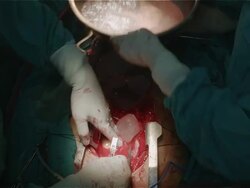 Surgeon and team harvest internal organ from living donor Stock Footage