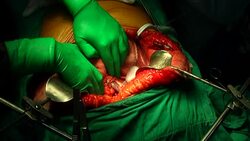 surgery operation Stock Footage