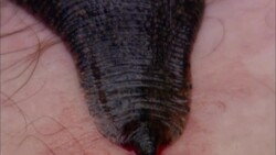 Blood oozes from the site where a swollen leech is attached to a man's leg. Stock Footage