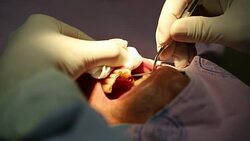 dental implant. Stock Footage