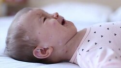Crying baby girl with measles Stock Footage