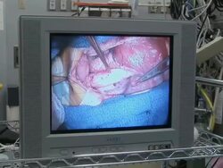 CU Monitor showing doctors stitching arteries of child's heart  /  Little Rock, Arkansas, USA Stock Footage