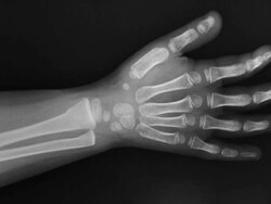 ZI on an x-ray of the wrist of a three year old girl showing a greenstick fracture of the distal radius and ulna Stock Footage
