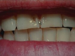 Dentists issue warning over fizzy vitamin drinks News Clip