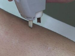 Laser Epilation Stock Footage