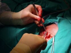 HD: Surgeon is stitching up the patient Stock Footage