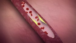  Less than six hours sleep per night may increase heart disease risk, study says Instructional Video