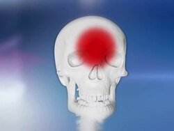 HD: Headache Animation Stock Footage