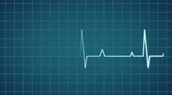 Electrocardiogram Stock Footage
