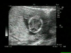 Twins, ultrasound scan. Stock Footage