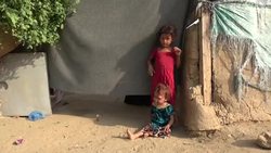 Malnutrition increases skin diseases among displaced Instructional Video