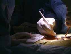  CU Two surgeons operating and assisting each other / Cagliari, Sardinia, Italy Stock Footage