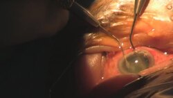 step 3. Surgery Cataract Eye. Category-B(Clip 1) Stock Footage