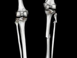 CAT Scan of Tibia Fibula Stock Footage