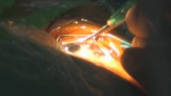 Surgery Eye Stock Footage